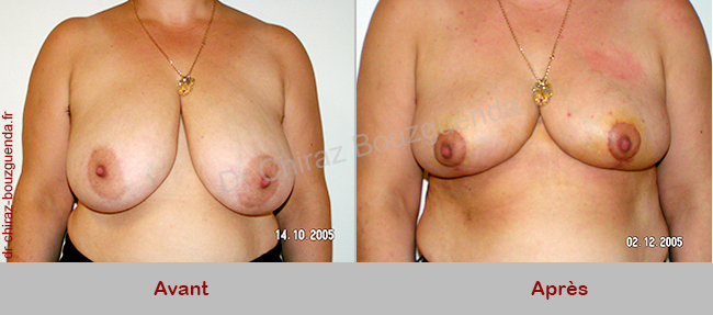 reduction mammaire tunisie photos avant apres