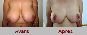 reduction mammaire photos avant apres tunisie