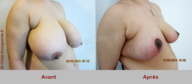 reduction mammaire photos tunisie