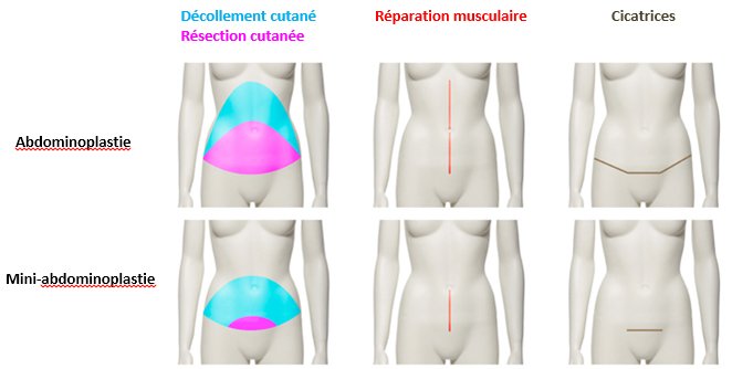 chirurgie esthetique ventre tunisie