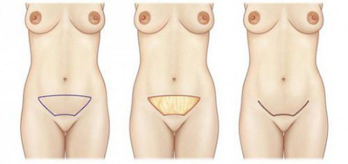 cicatrice abdominoplastie tunisie