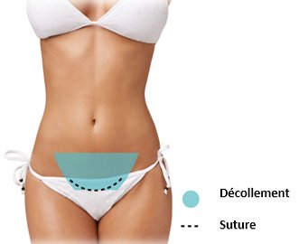 mini abdominoplastie tunisie