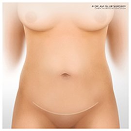 resultat abdominoplastie tunisie