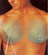 cicatrices gynecomastie tunisie