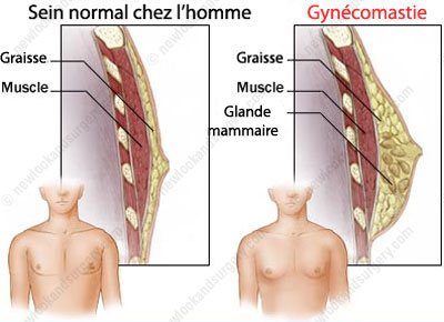 gynecomastie tunisie