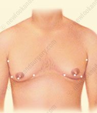 gynecomastie tunisie