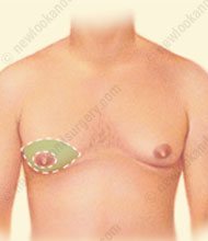 prix gynecomastie tunisie