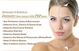 injection prp visage